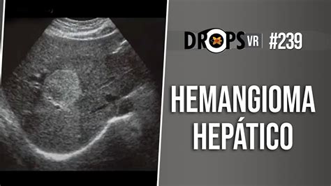 hemangioma hepatico-1
